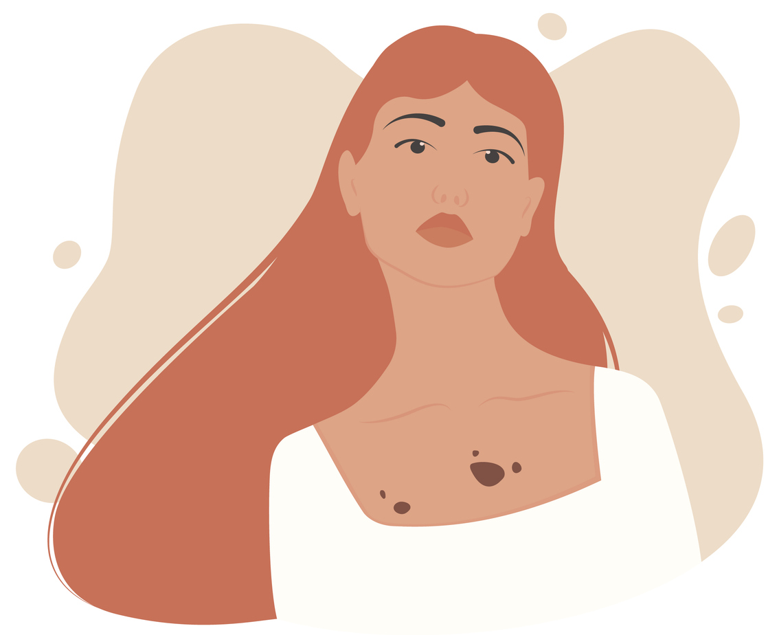 Родинки: как проверять кожу?